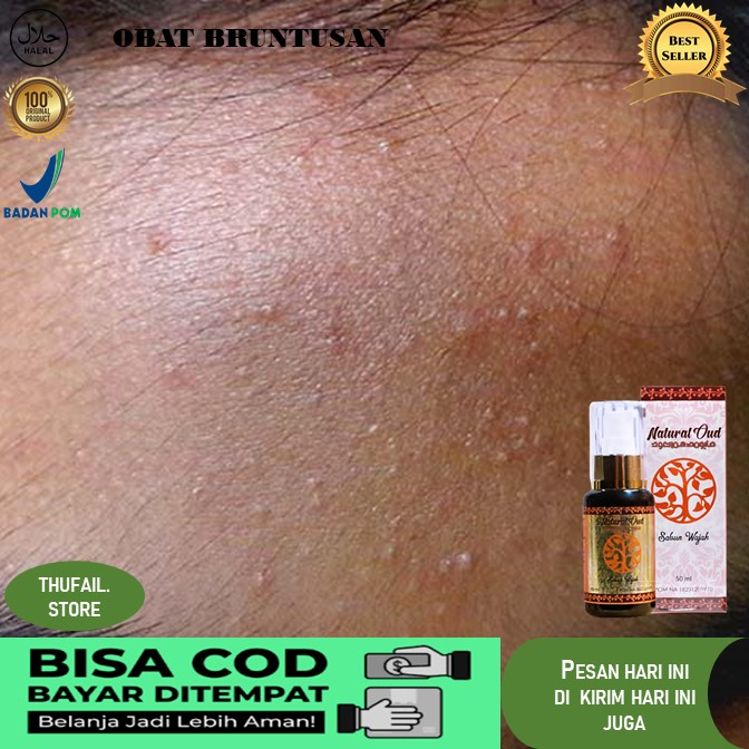 obat bruntusan obat bruntusan wajah Sabun Penghilang Beruntusan Di Wajah, di Jidat, Bruntusan di Baw
