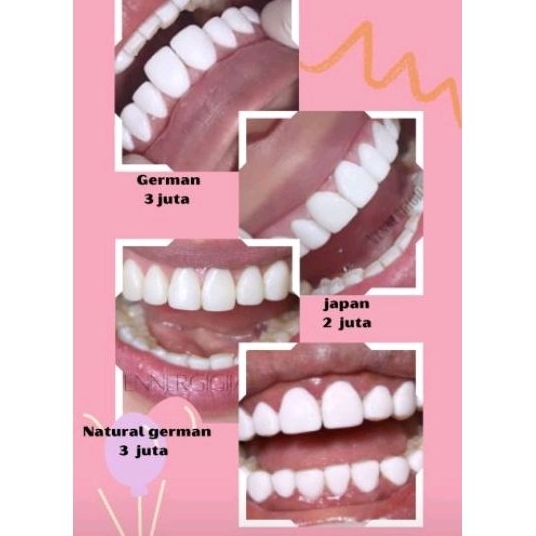 veneer gigi