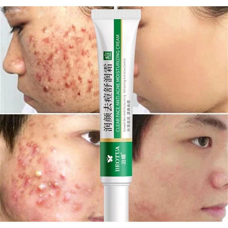 Gel Wajah Pelembap, Kontrol Minyak Jerawat BEOTUA Clear Face Anti Acne Moisturizing Cream/Krim Penghilang Jerawat Herbal