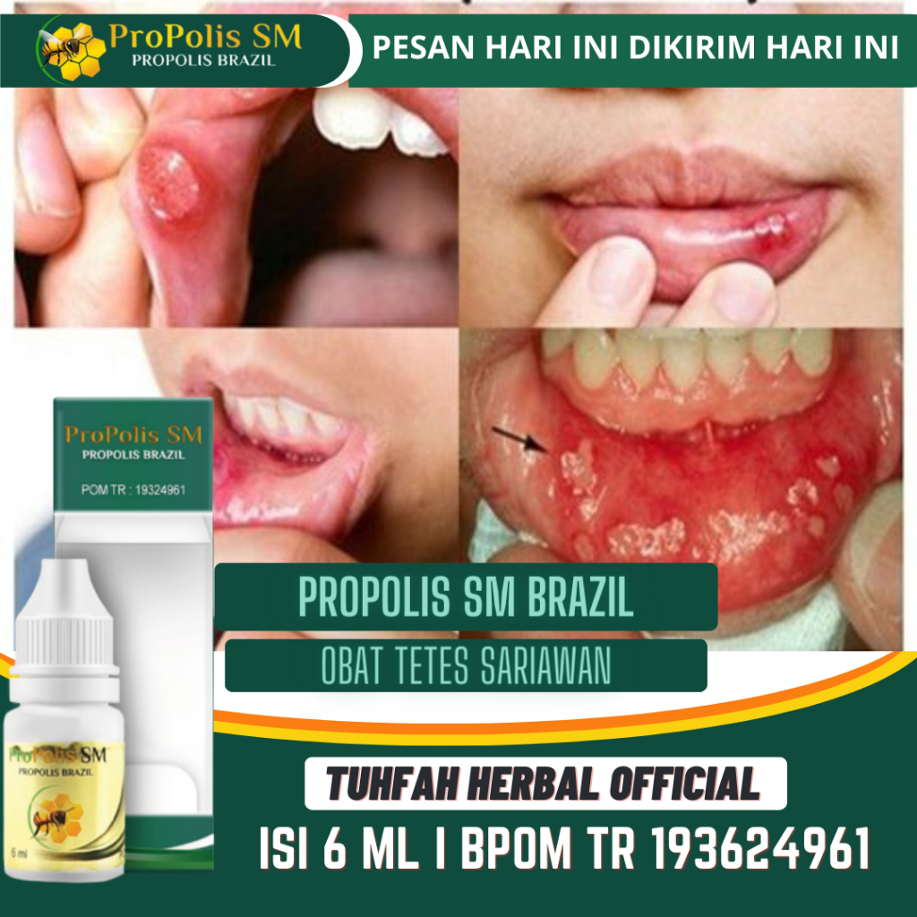 Obat Sariawan, Obat Sariawan Mulut, Obat Sariawan Di Lidah, Obat Sariawan Di Bibir, Obat Menghilangk