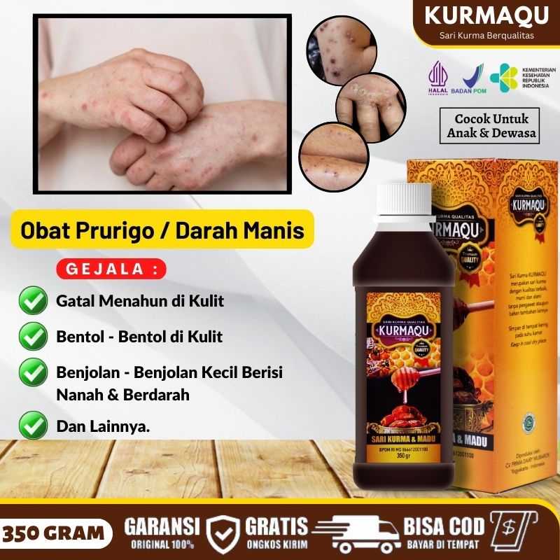 Obat Gatal Prurigo, Obat Bentol - Bentol Bernanah di Kulit, Penghilang Gatal Menahun, Obat Borok Ber