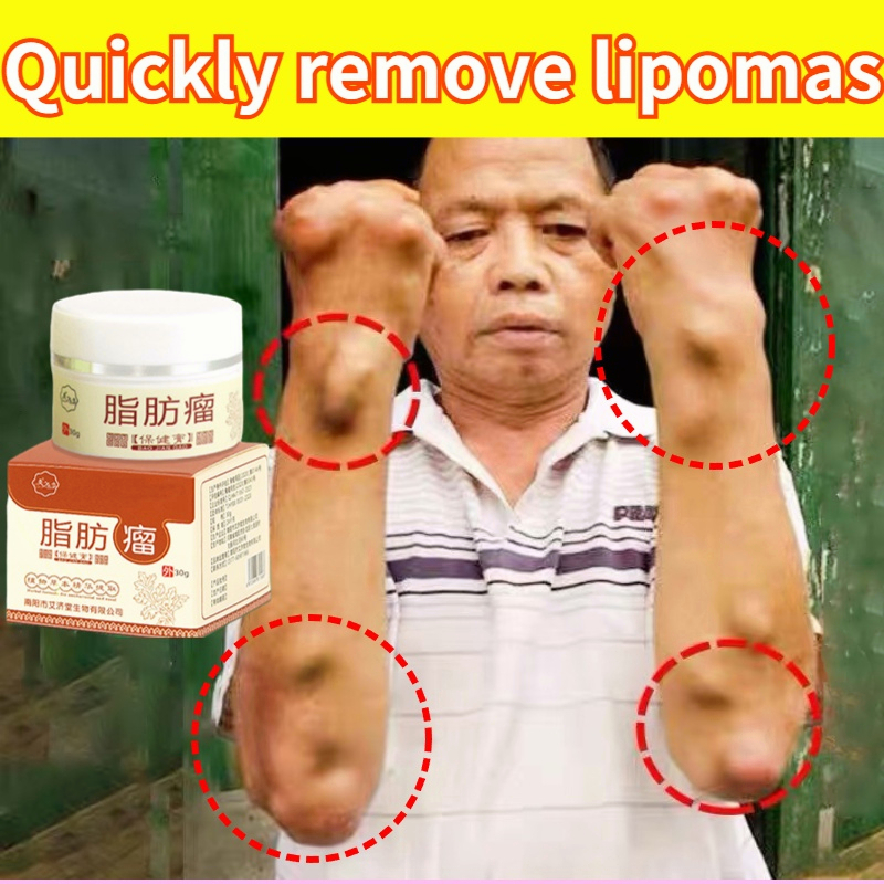 Obat Benjolan 30g Krim Penghilang Lipoma Gel Khusus untuk Menghilangkan Beberapa Lipoma Tunggal Lipoma Subkutan Benjolan Benjolan