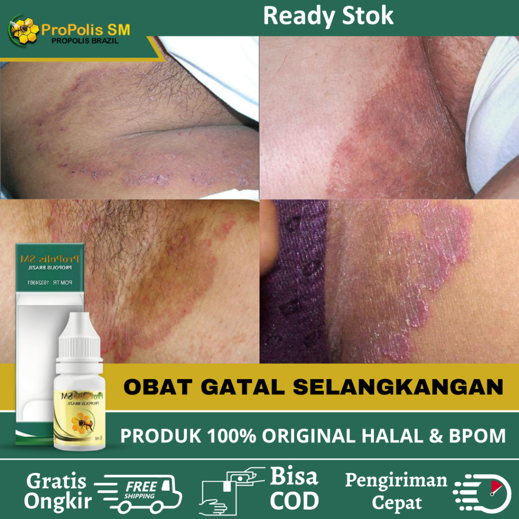 Obat Selangkangan Hitam, Obat Gatal Selangkangan, Obat Selangkangan Babak, Obat Infeksi Jamur Selang