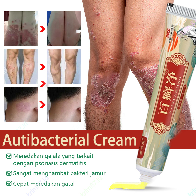 Obat Gatal Salep Obat Gatal Kulit Krim Gatal 20ml Salep antibiotik psoriasis antibakteri gatal krim krim dermatitis dan psoriasis psoriasis eksim eksim antid gatal salep