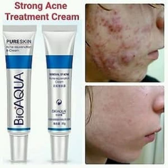 [ORI] Bioaqua Acne Pure Skin Cream Obat Jerawat Paling Ampuh Menghilangkan Jerawat dan Bekas Jerawat