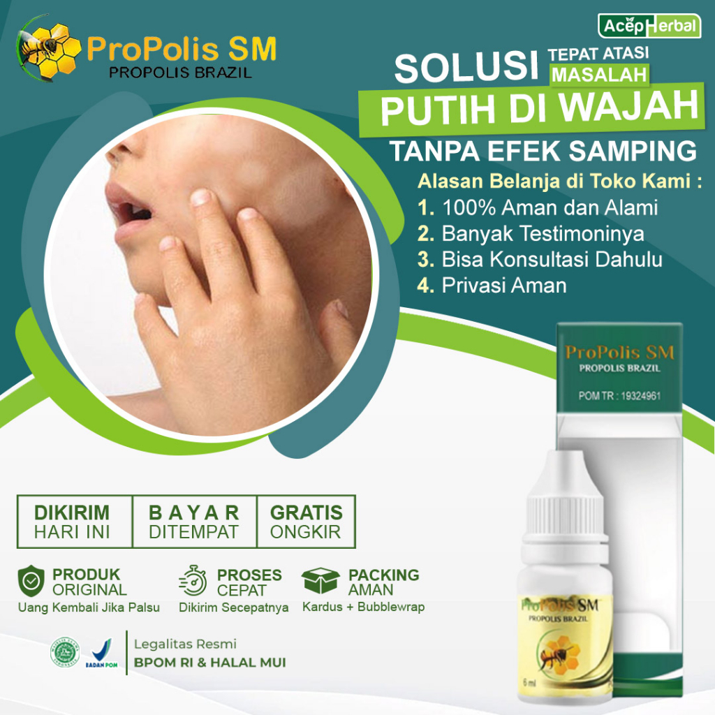 PROPOLIS SM 100% Obat Untuk Menghilangkan Balas Bogo, Salep Balas Bogo,Obat Penghilang Hapur, Obat P