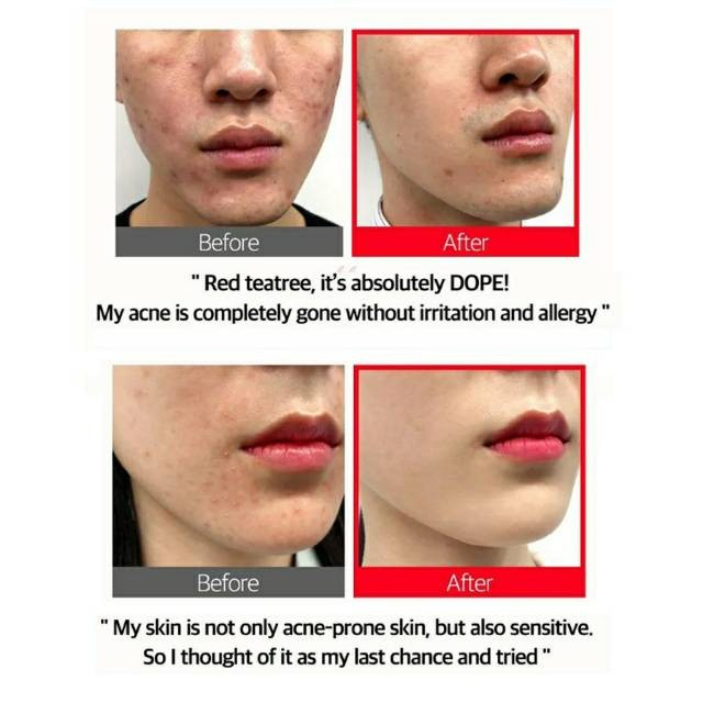 Somebymi Red Teatree Cicassoside Final Solution Serum 50ml EXP 06 2023