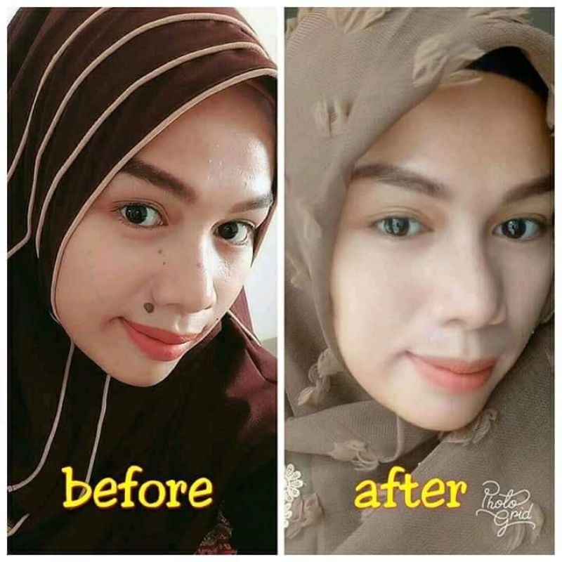 penghilang tahilalat kutil mata ikan