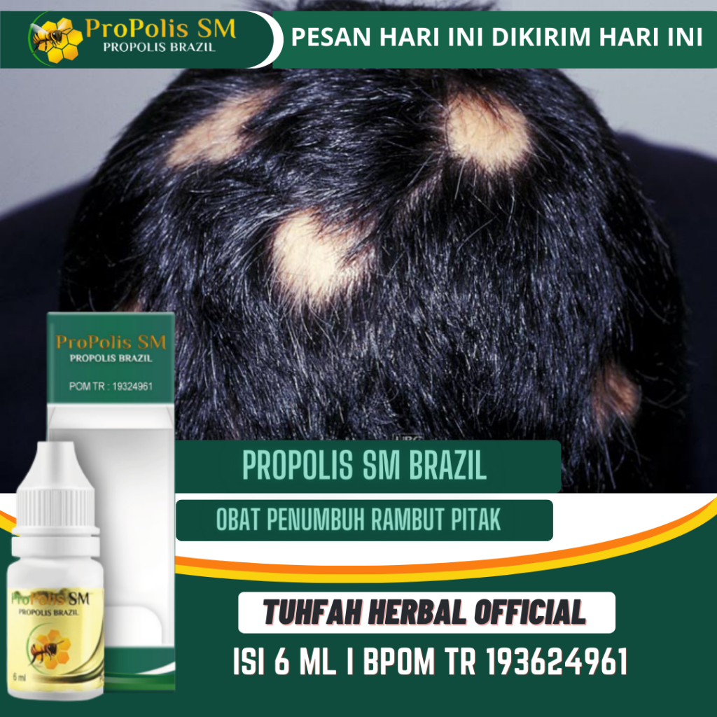Obat Alopecia Areata, Penumbuh Rambut Pitak, Penumbuh Rambut Botak, Rambut Rontok, Botak Koin, Tinea