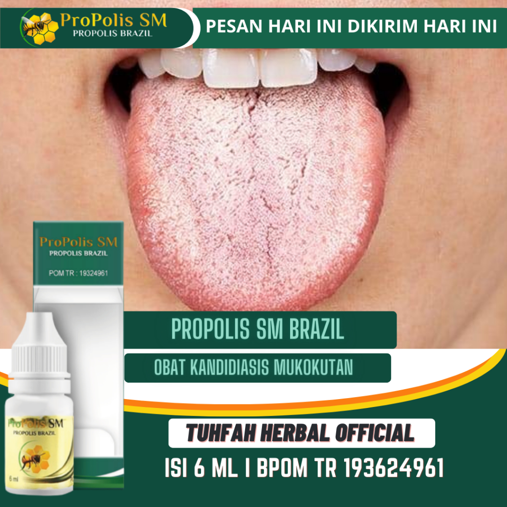 Obat Kandidiasis Mukokutan, Lidah Putih, Lidah Pecah Pecah, Lidah Putih Berjamur, Pembersih Lidah Pu