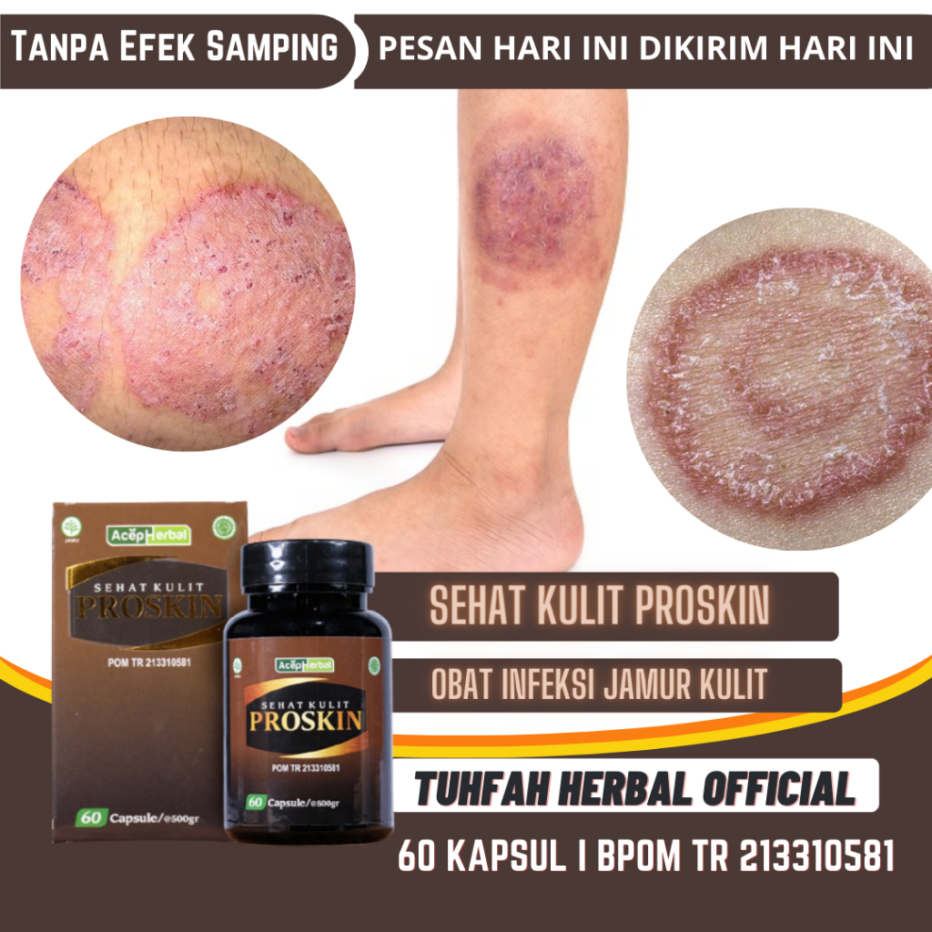 PROSKIN Kapsul Binahong Obat Infeksi Jamur Kulit, Obat Jamur Kulit, Obat Gatal Kulit, Salep Jamur Ku