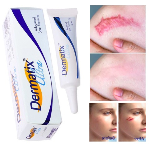 Dermatix Ultra Advanced Scar Gel 15Gr Original 100% Salep Penghilang Bekas Luka Keloid Anti Scar Stretchmark