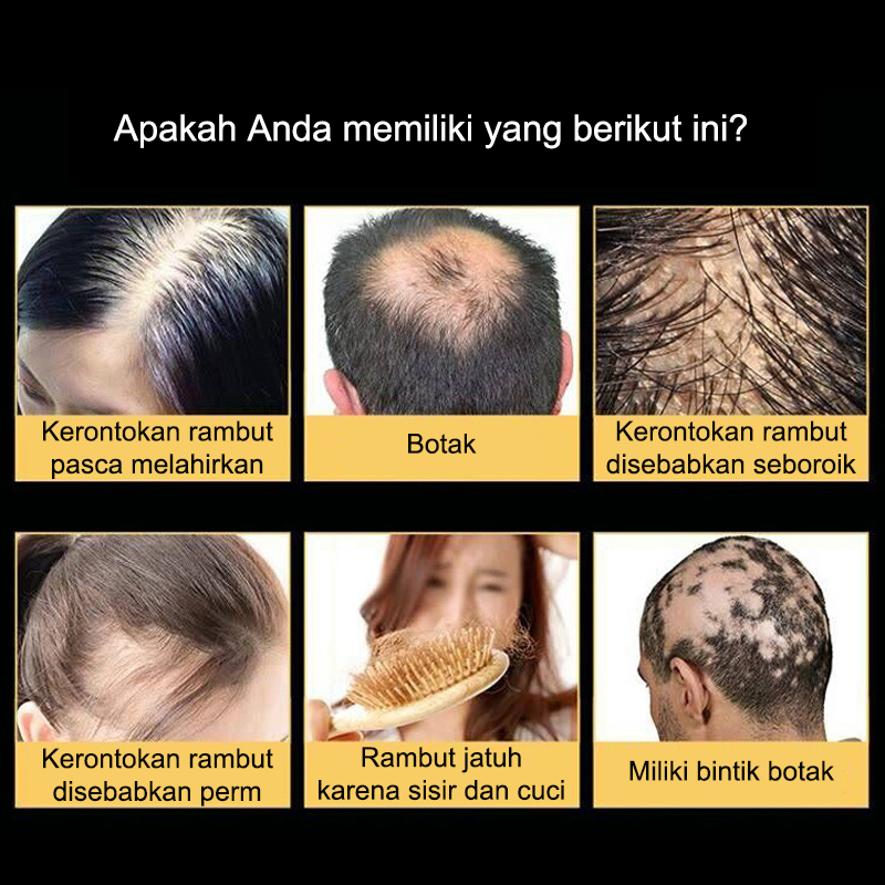 Penumbuh rambut botak Serum penumbuh rambut 30ml Penumbuh rambut cepat Kontrol minyak Menyuburkan rambut Mencegah Kebotakan