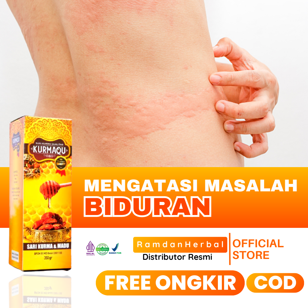 Obat Herbal Biduran Kronis Obat Biduran Menahun Kaligata Obat Darah Manis Alergi Dingin Kurmaqu