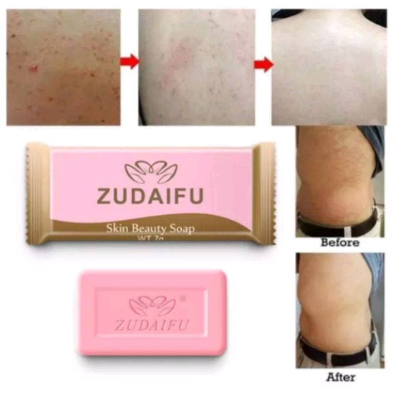 Sabun Gatal Zudaifu 7gr sabun gatal Eksim kadas panu psoriasis