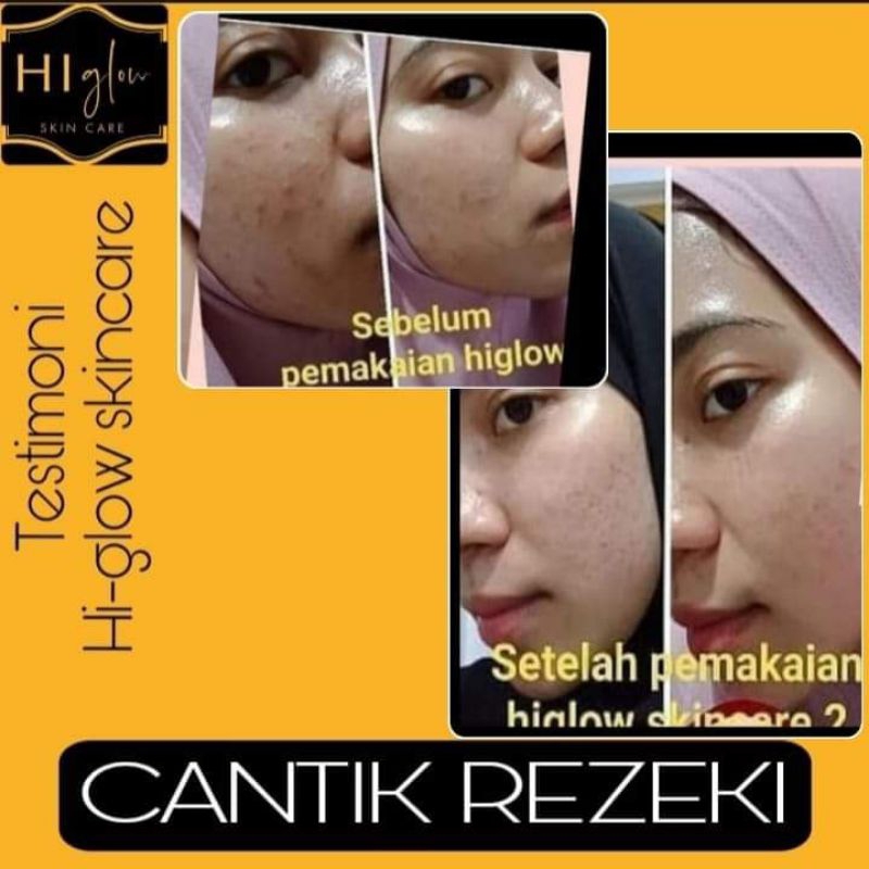Hi glow original! higlow skincare paket premium glow, acne dan flek (best seller)