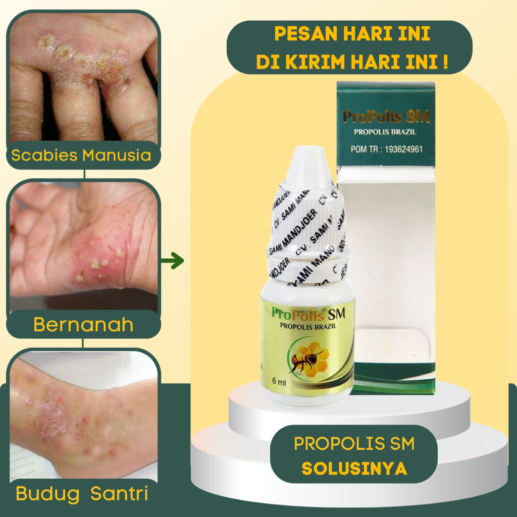 Obat Gatal Kulit, Obat Jamur Kulit, Obat Koreng di Kaki Gatal Gatal, Obat Borok di Tangan, Obat Gata