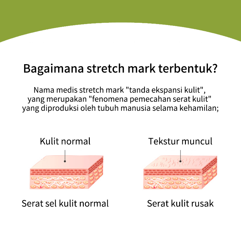 Stretch Mark Cream Mama Choice Stretch Mark 30ml  Stretch Mark Dan Obesity Mark Krim Mengencangkan Perut Stretch Mark Removal Cream Krim Perawatan Postpartum