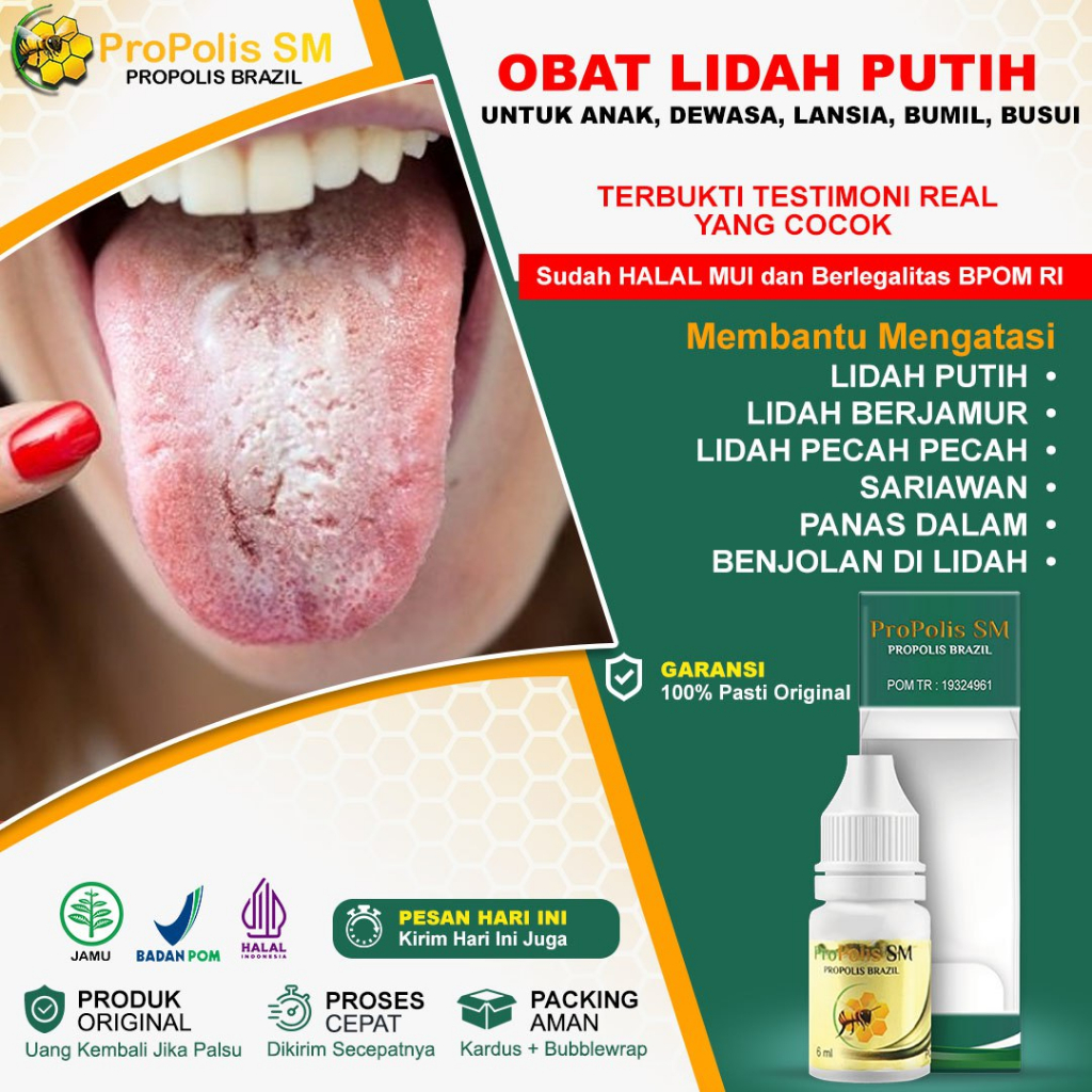 Obat Lidah Putih Obat Lidah Pecah Obat Lidah Berjamur Obat Lidah Tak Ada Rasa Obat Radang Lidah Glos