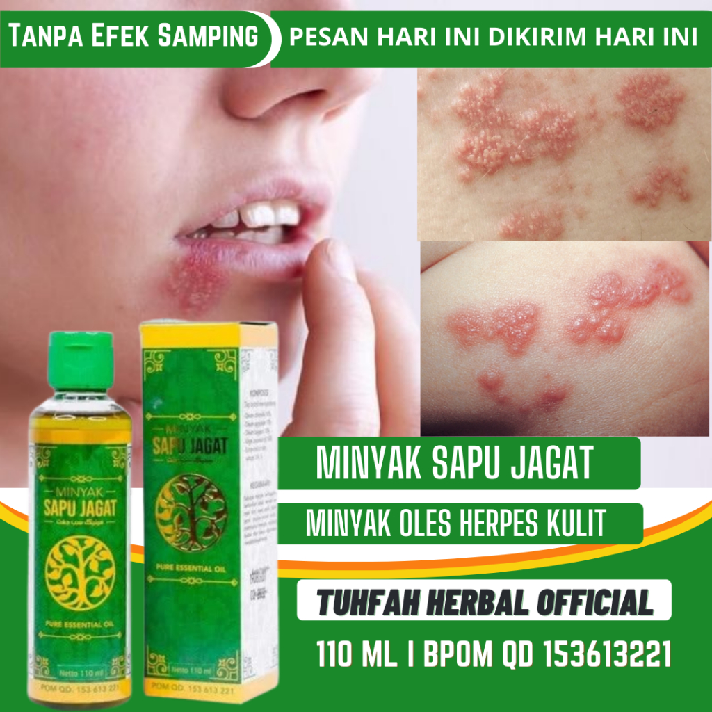 Minyak Oles Herpes Pada Anak dan Dewasa, Herpes Kulit, Obat Herpes Bayi, Herpes Genital, Herpes di B