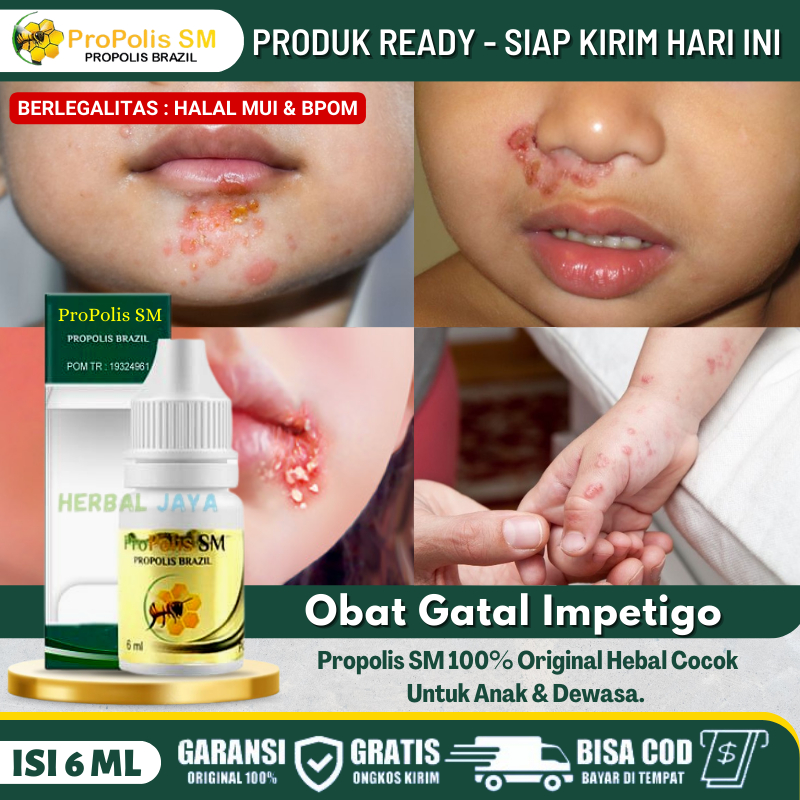 Obat Oles Alami Gatal Impetigo Pada Anak Aman Jika Tertelan, Infeksi Kulit Menular Pada Anak, Gatal 