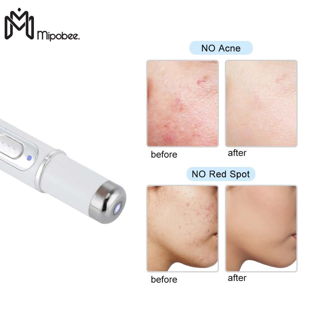 Pen LED Laser Biru Penghilang Bekas Jerawat / Acne Treatment Pen Laser