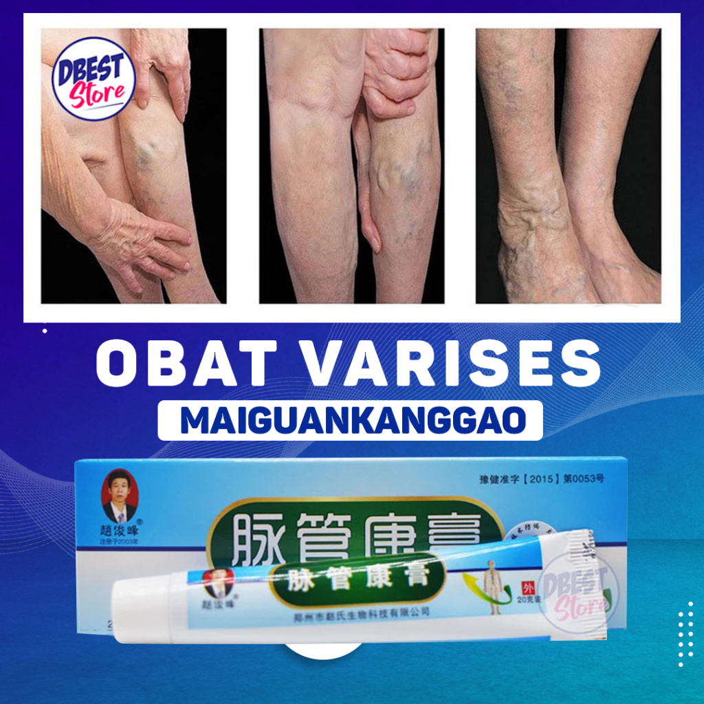 Maiguankanggao Salep Krim Obat Varises Parises Farises Urat Farises