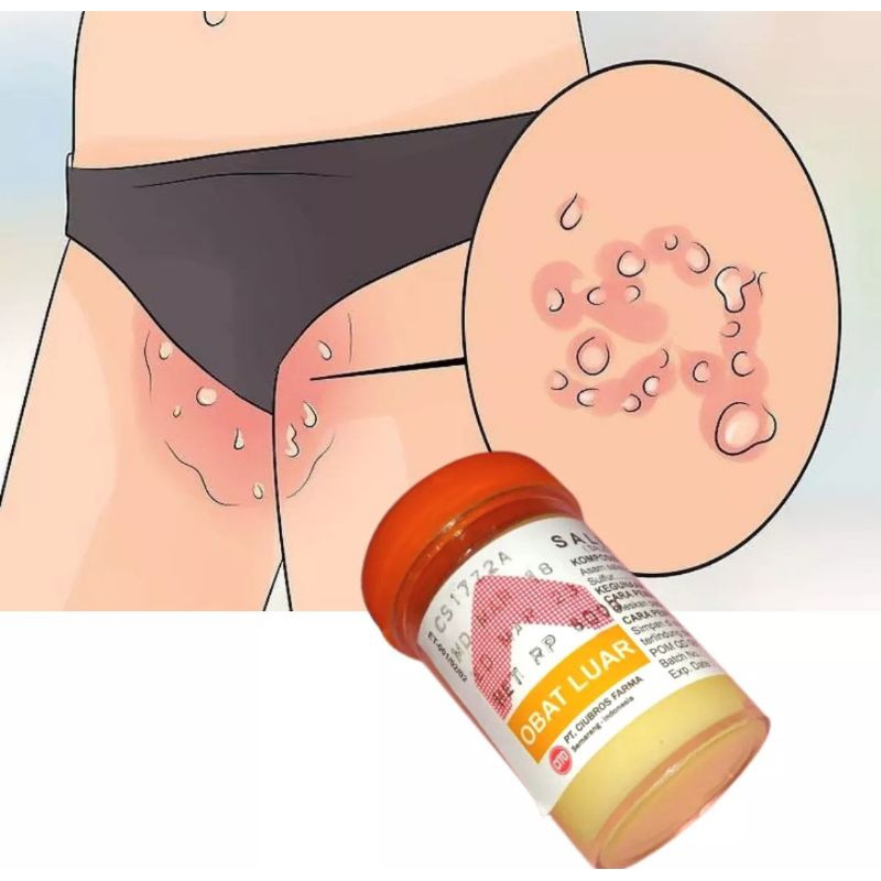 Salep Zwafel 24 Original 100% Salep Gatel Kudis Kurap Kutu Air Panu