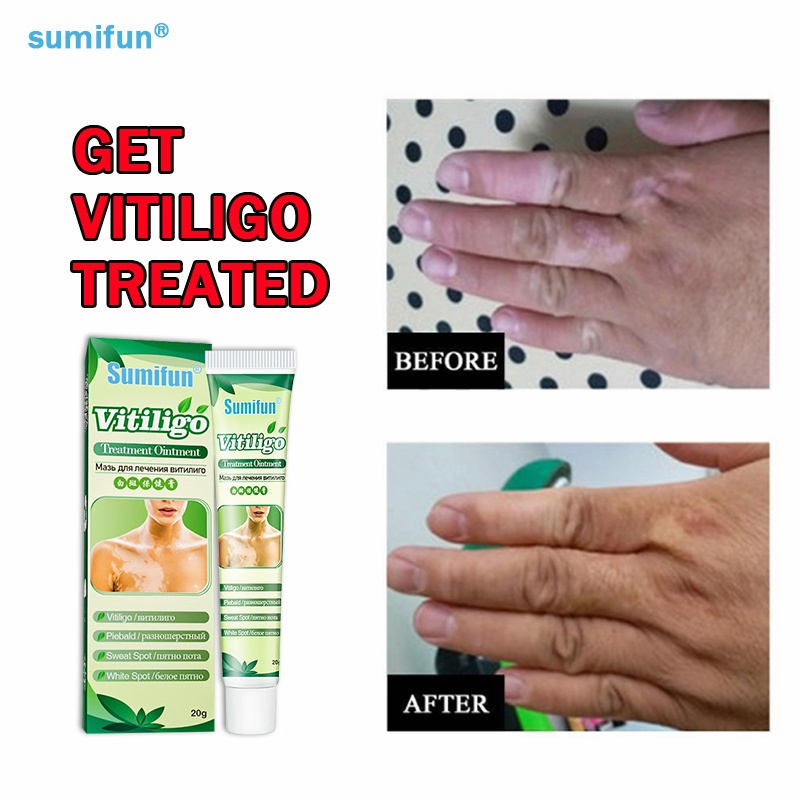 100%ORI Sumifun Obat Vitiligo Salep Tiange Penghilang Bercah Putih 20g