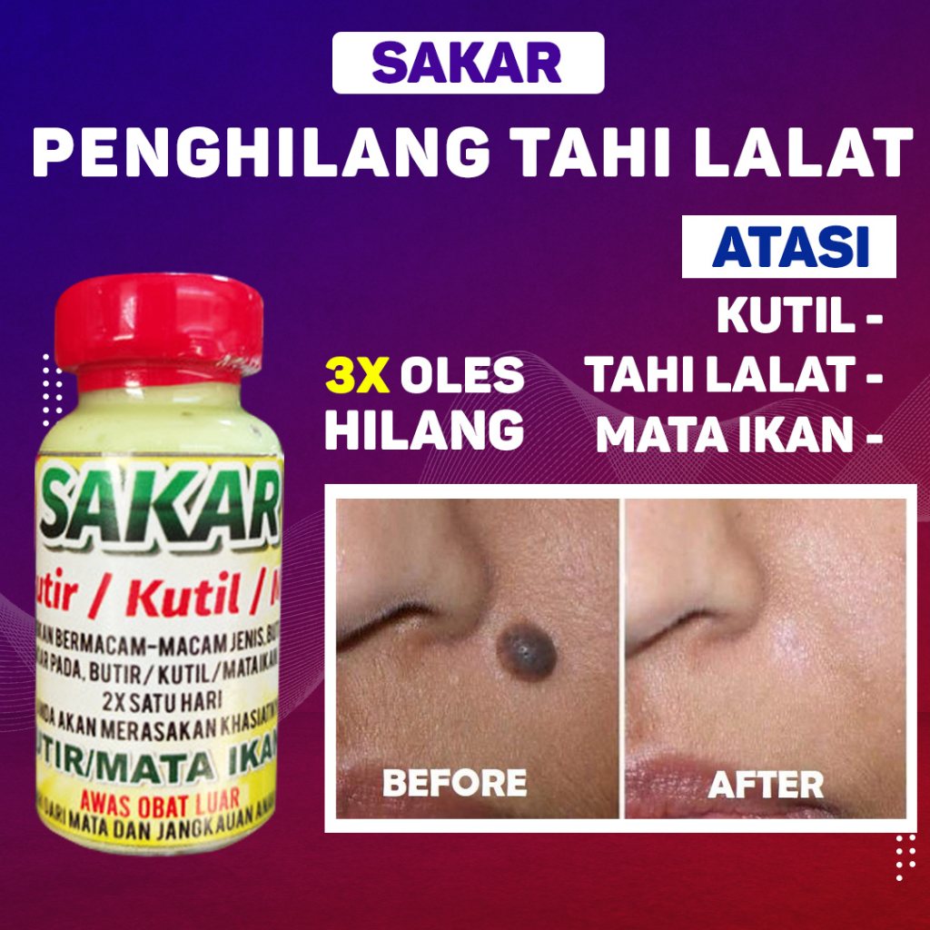 Sakar Obat Kalimantan Penghilang Kutil Tahi Lalat , Butir &amp; Mata Ikan