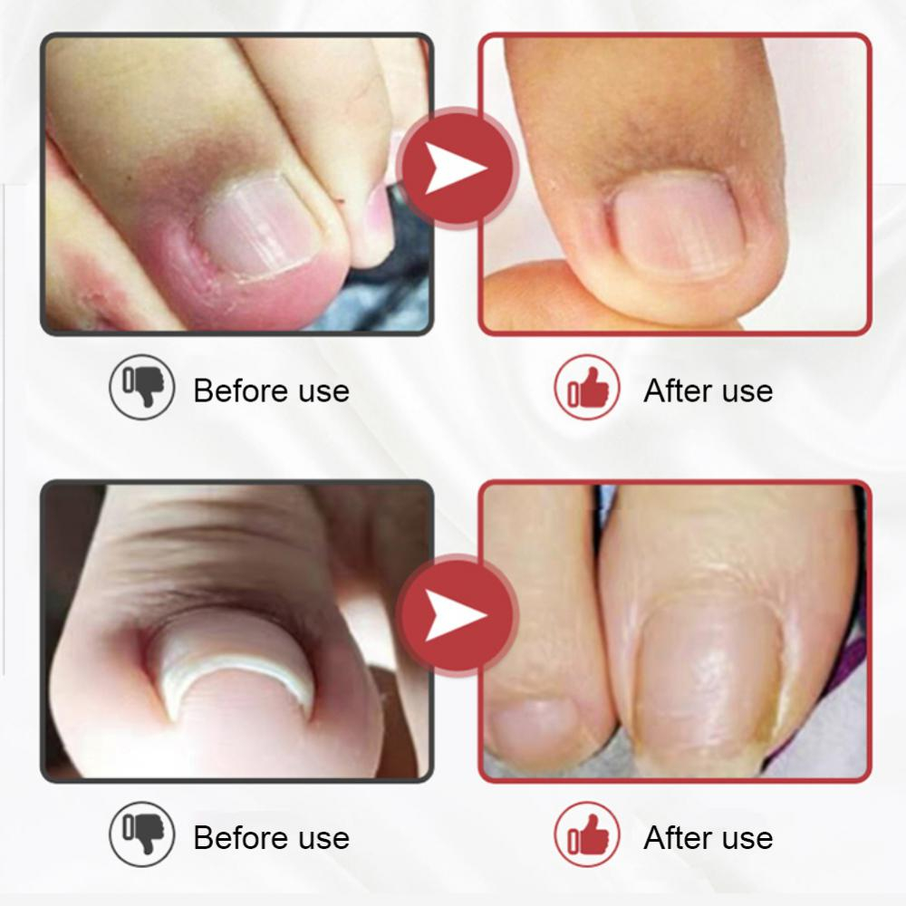 SUAI Ai Armor Guards Remove Ingrown Nail Essentl Oil Nail Groove Hair Paronychia Onychomycosis Tools