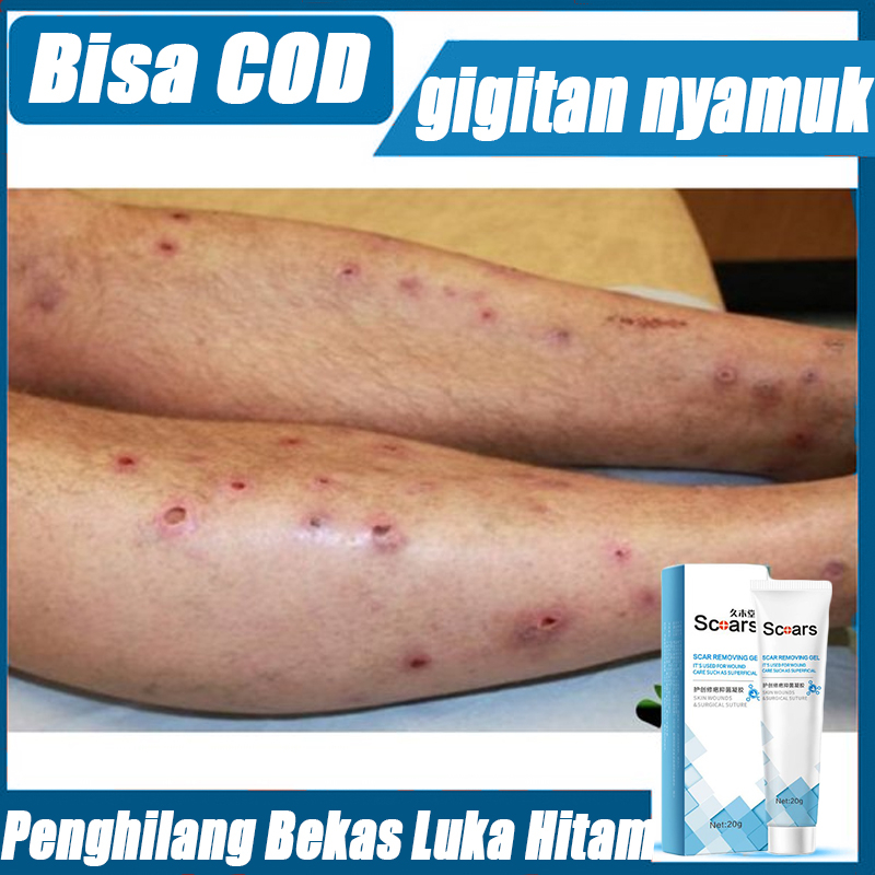 salep bekas luka koreng hitam penghilang Bekas luka koreng hitam di kaki Penghilang Bekas gigitan ny