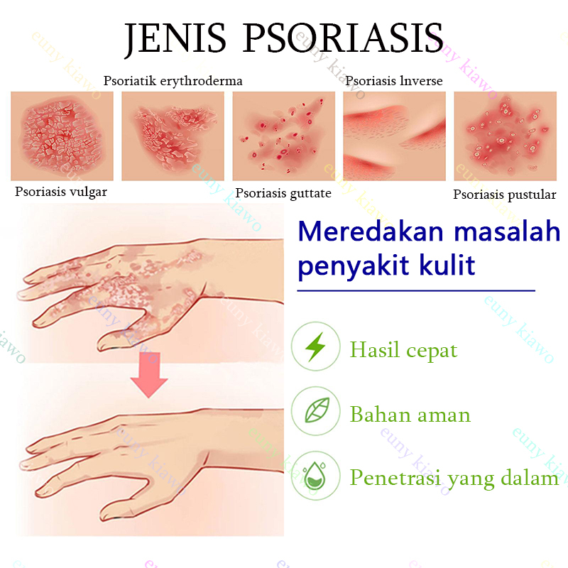Obat Gatal Salep gatal Salep eksim Obat psoriasis Salep psoriasis 30G 【100% Original】Salep Kulit Jamur Dermatitis Psoriasis Eksim Jamur Kurap Alergi Kulit Cream Obat Gatal