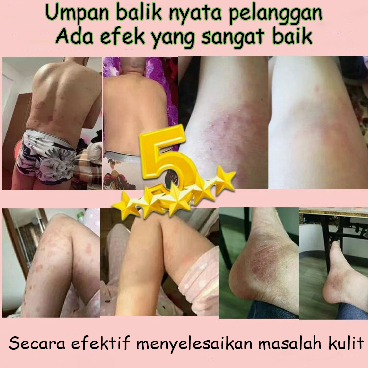 Obat Gatal Salep gatal Salep eksim Obat psoriasis Salep psoriasis 30G 【100% Original】Salep Kulit Jamur Dermatitis Psoriasis Eksim Jamur Kurap Alergi Kulit Cream Obat Gatal