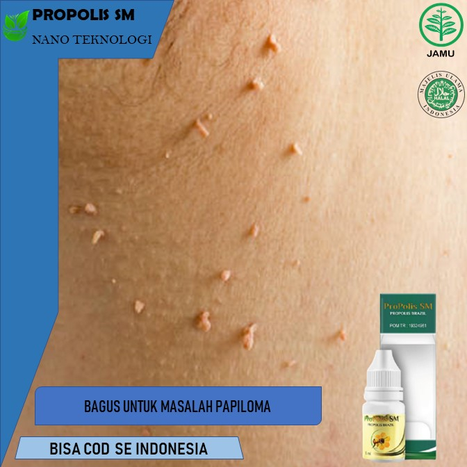 obat papiloma  obat papiloma leher Obat Daging Tumbuh/Skin Tag, Kutil Di Kulit/Kelamin, Kelenjar Get