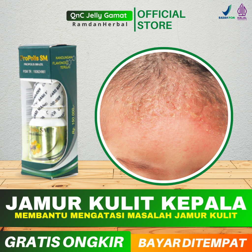 COD Obat Jamur Di Kulit Kepala Anak Tinea Capitis Kulit Kepala Bersisik Gatal Kurap Kepala Propolis