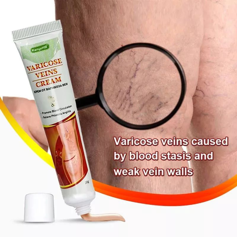 varicose vein cream,cream varises kaki-salep varises