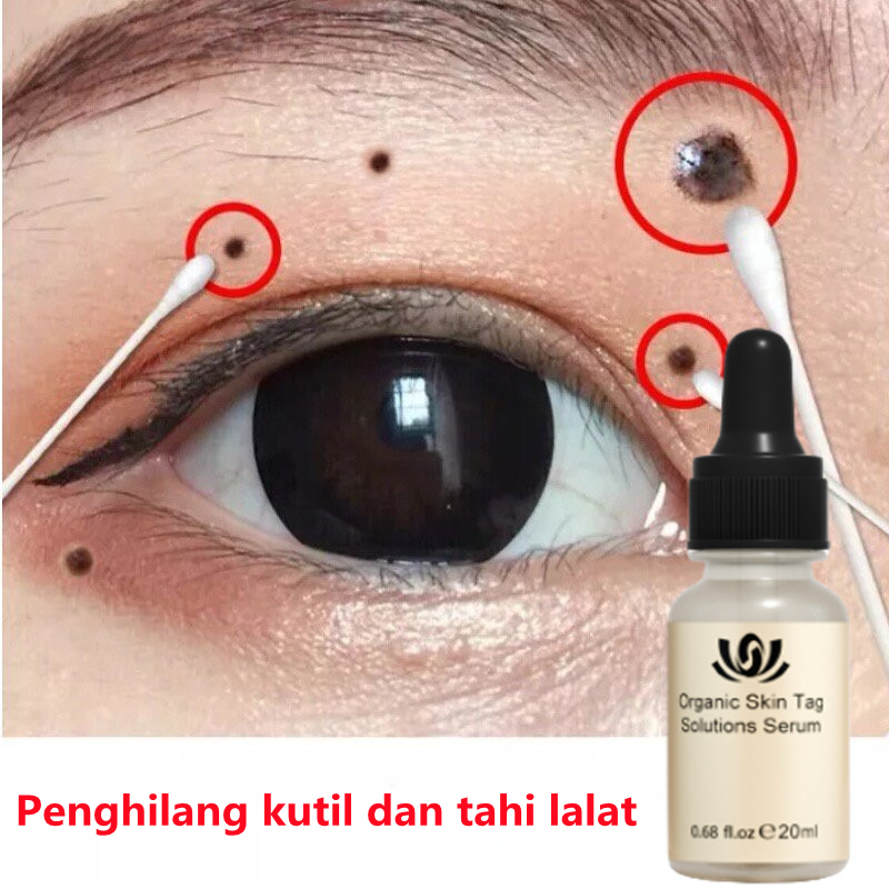 Wart Removal Cream Repair And Clean Skin Tag Papilloma Remover 20g - Menghilangkan Kutil Tahi Lalat Mata Ikan Menghilangkan Kutil Tahi Lalat Mata Ikan Wart Remover - Salep Obat Penghilang Tahi Lalat dan Kutil