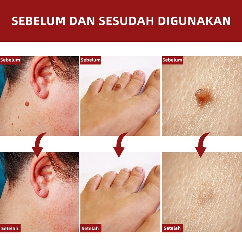 Wart Removal Cream Repair And Clean Skin Tag Papilloma Remover 20g - Menghilangkan Kutil Tahi Lalat Mata Ikan Menghilangkan Kutil Tahi Lalat Mata Ikan Wart Remover - Salep Obat Penghilang Tahi Lalat dan Kutil