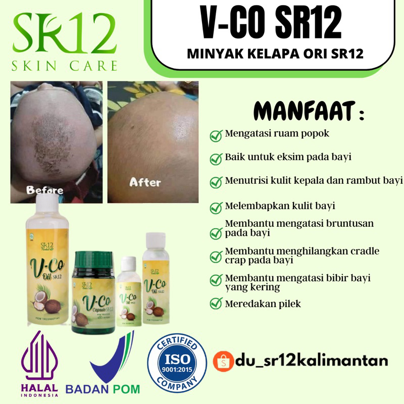 MINYAK KELAPA ASLI , VCO OIL , VCO SR12 , MENGATASI CRADLE CRAP PADA BAYI , OBAT ALERGI BAYI , MINYAK URUT BAYI