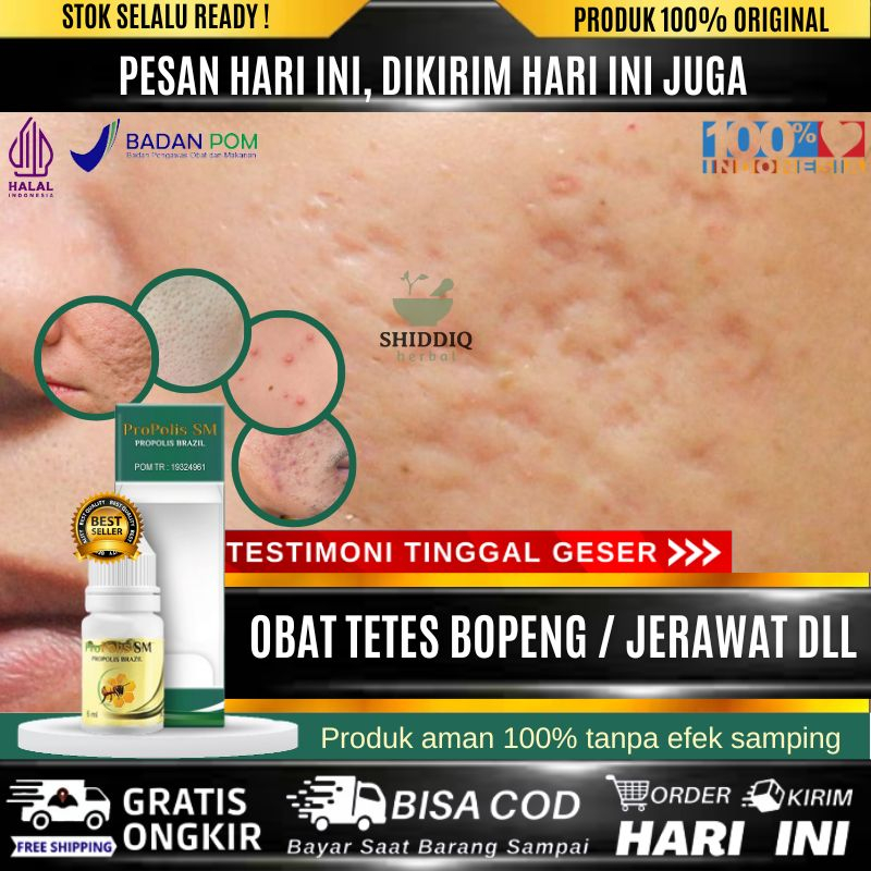 Obat Tetes Menghilangkan Bopeng Bekas Cacar Yang Sudah Lama, Hilangkan Bopeng Bekas Luka Di Wajah, P