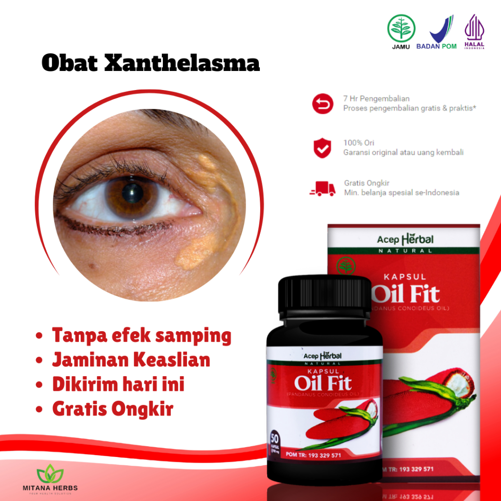 Obat Xanthelasma, Obat Lemak Di Kelopak Mata, Obat Gumpalan Lemak Di Kelopak Mata, Penghilang Plak K
