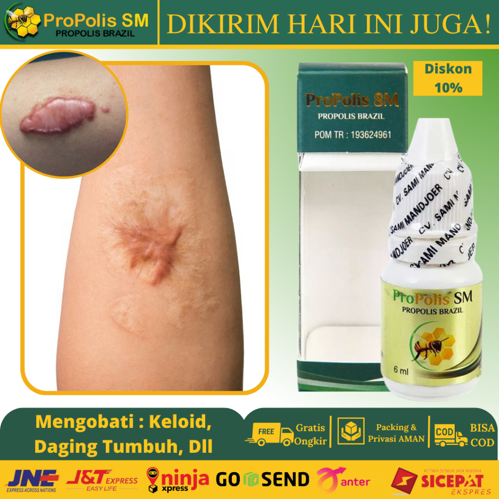 Obat Keloid, Obat Bekas Luka Menonjol - Obat Penghilang Keloid Berkerut, Penghilang Bekas Luka Menon
