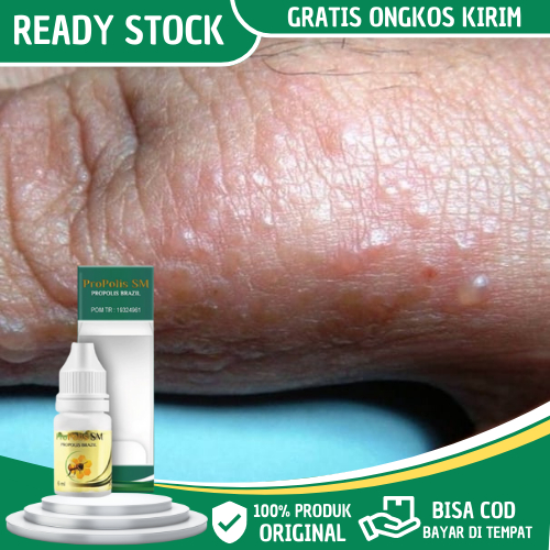 Obat Gatal Berair di Jari Tangan, Obat Gatal Bintik Berair di Tangan, Obat Penghilang Gatal Berair d