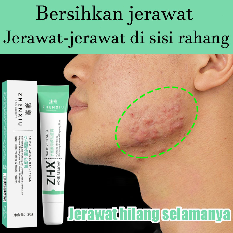 Krim Jerawat Acne Spot Treatment Cream SALICYLIC ACID ANTI ACNE CREAM 30ml Acne Spot Treatment Gel [BPOM]