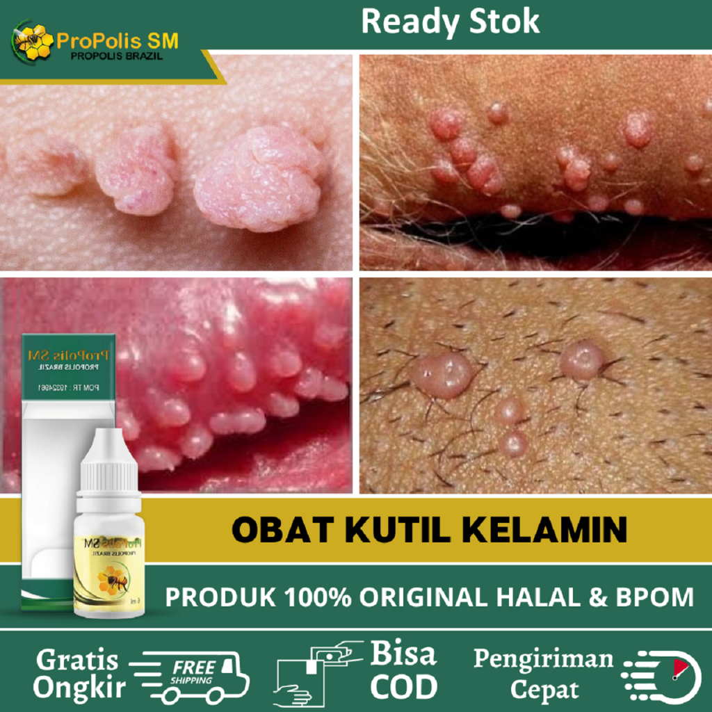 Obat Kutil Kelamin Hpv, kutil Kelamin Pria, Kutil Kelamin Wanita, Bintik Putih Di Kelamin, Perontok 