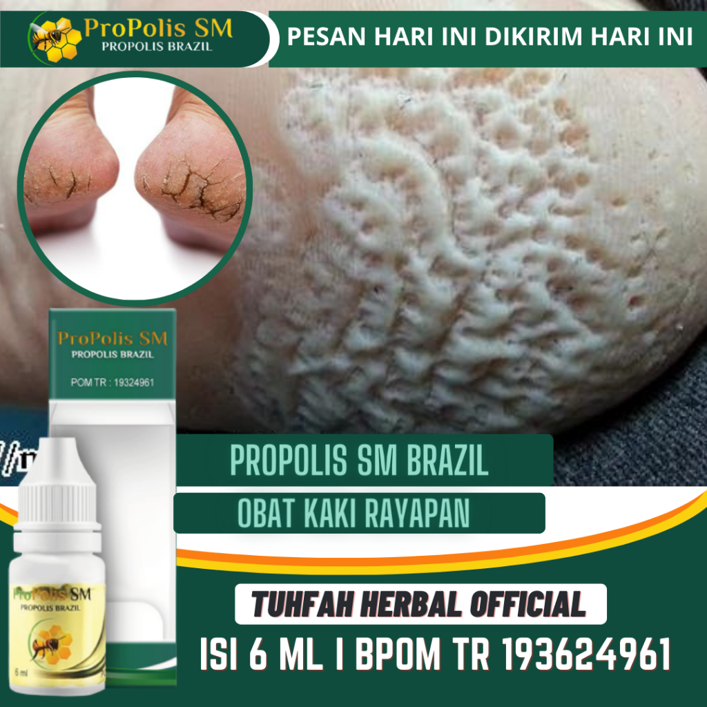 Obat Telapak Kaki Bolong-Bolong dan Bau Kutu Air, Kaki Rayapan, Rorombeheun, Pitted Keratolysis, Kak