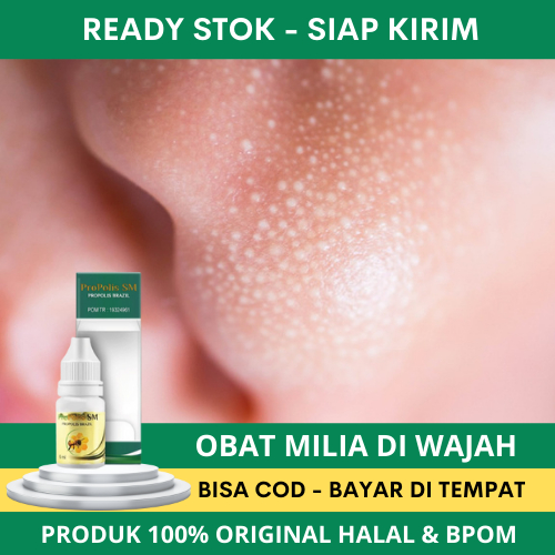 Obat Milia - Obat Milia Di Bawah Mata - Obat Milia Pada Wajah - Obat Milia Di Kelopak Mata - Obat Mi