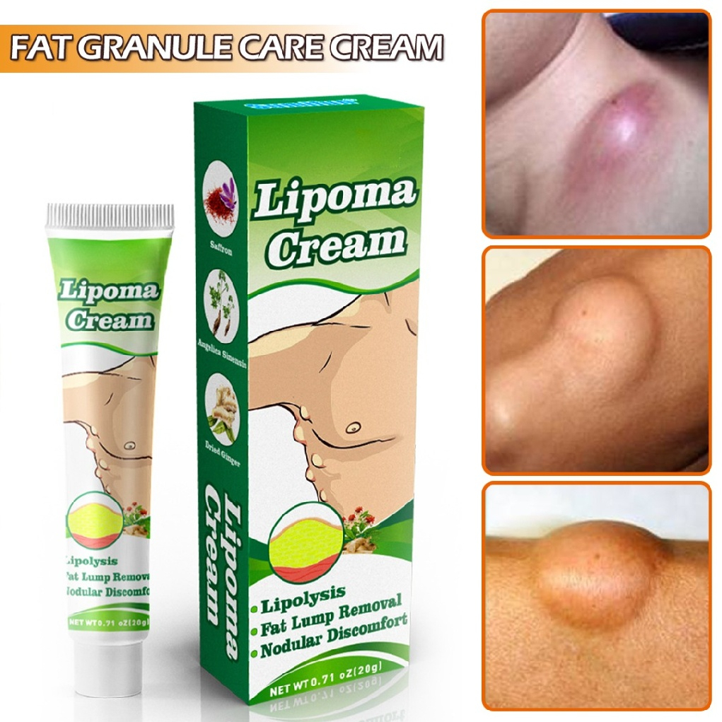 Sumifun Obat Benjolan Lipoma Salep Lipoma Cream Herbal/Fibroid/Benjolan Subkutan/Leher Benjolan/Punggung Pundak Benjolan/Kista Ganglion Benjolan/Kelenjar Tiroid Limfoma Limpoma Kelenjar-20g Lipoma Remover Treatment Ointment