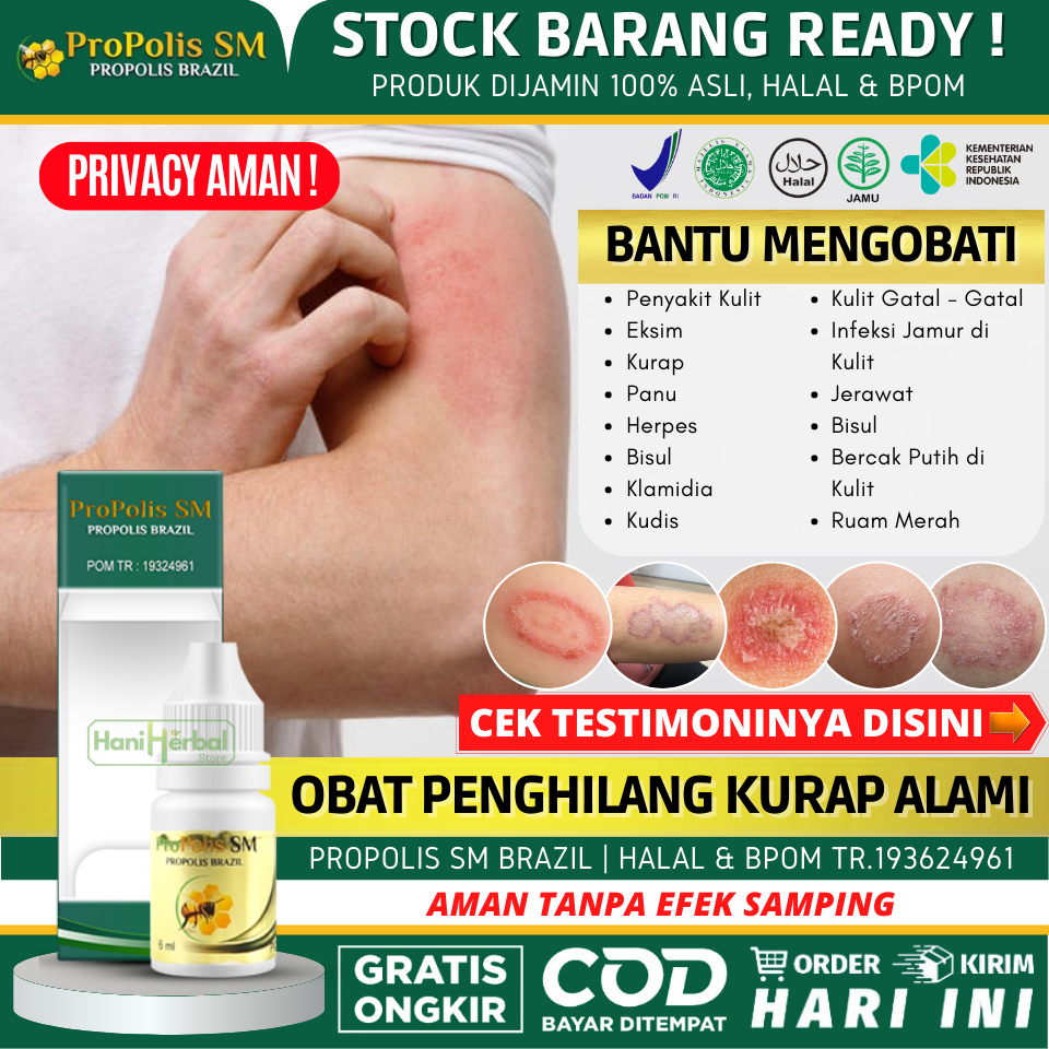Obat Alami Untuk Kurap di Wajah, Leher, Tangan, Kaki, Selangkangan, Obat Oles Penghilang Kurap / Pan